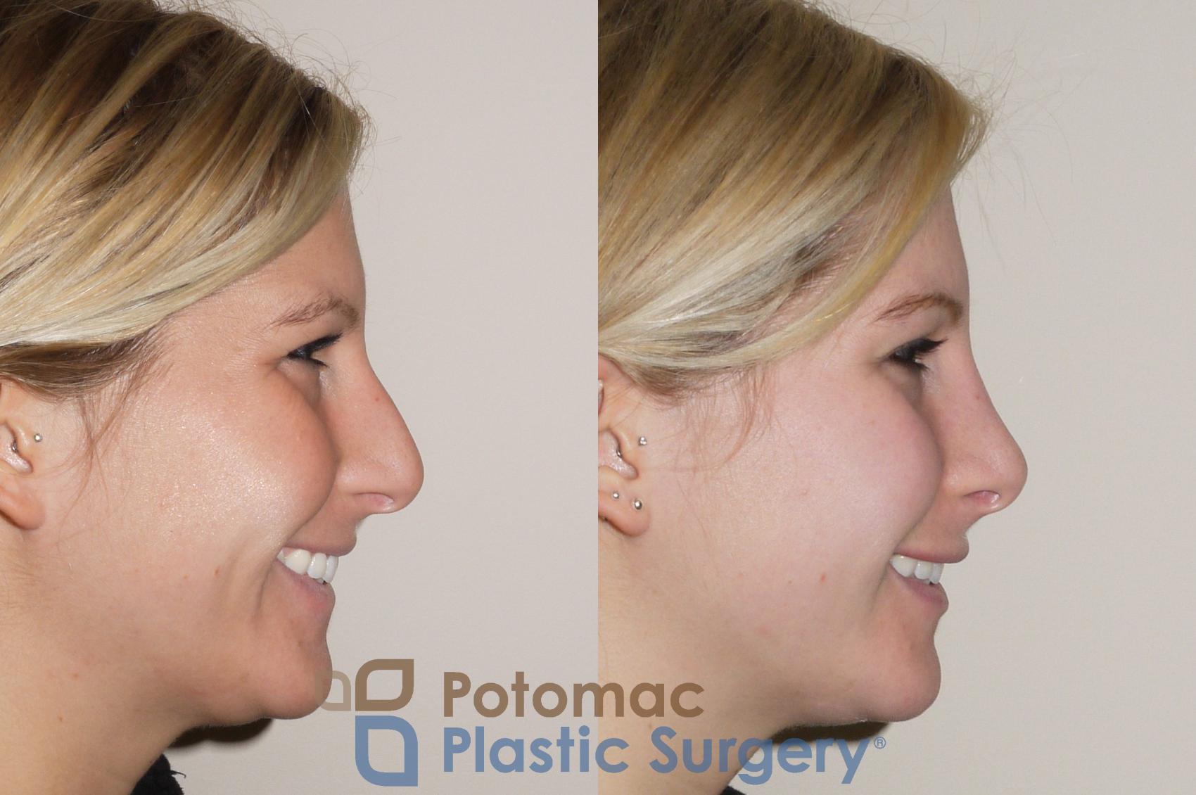 Before & After Rhinoplasty - Cosmetic Case 43 Right Side Smile View in Washington DC & Arlington , DC