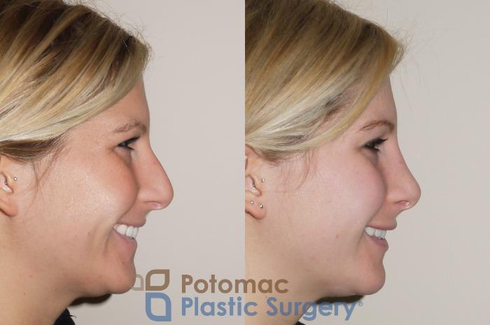 Before & After Dermal Fillers Case 43 Right Side Smile View in Washington, DC