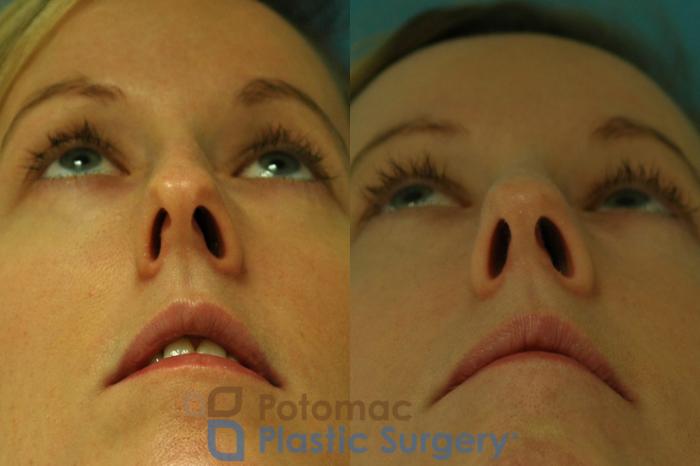 Before & After Rhinoplasty - Medical Case 5 Below View in Washington DC & Arlington , DC