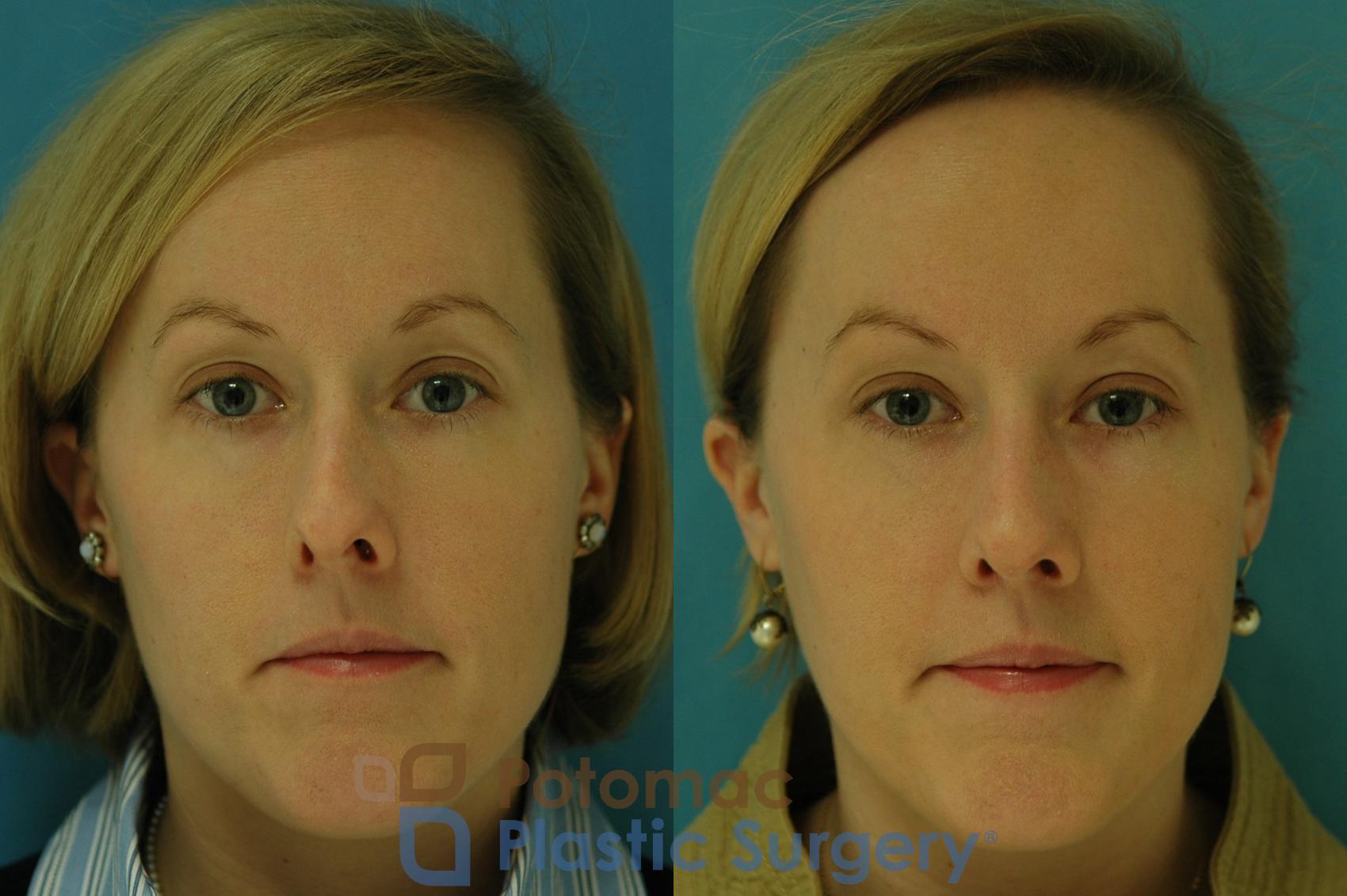 Before & After Rhinoplasty - Medical Case 5 Front View in Washington DC & Arlington , DC