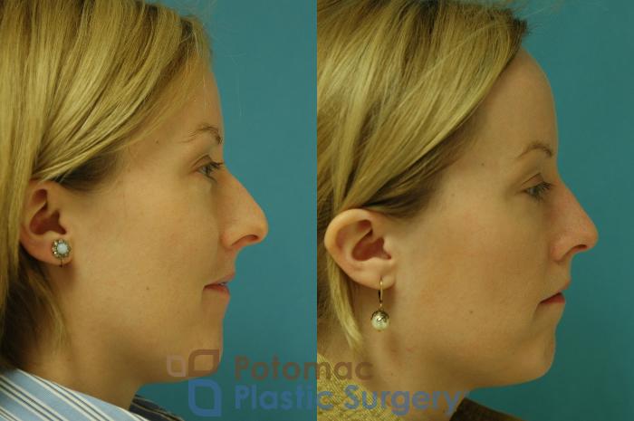 Before & After Rhinoplasty - Cosmetic Case 5 Right Side View in Washington DC & Arlington , DC
