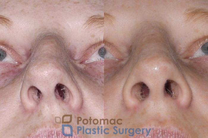 Before & After Rhinoplasty - Medical Case 52 Below View in Washington DC & Arlington , DC