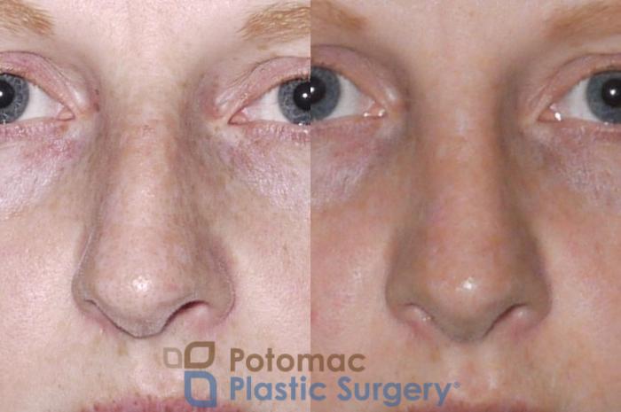 Before & After Rhinoplasty - Medical Case 52 Front View in Washington DC & Arlington , DC