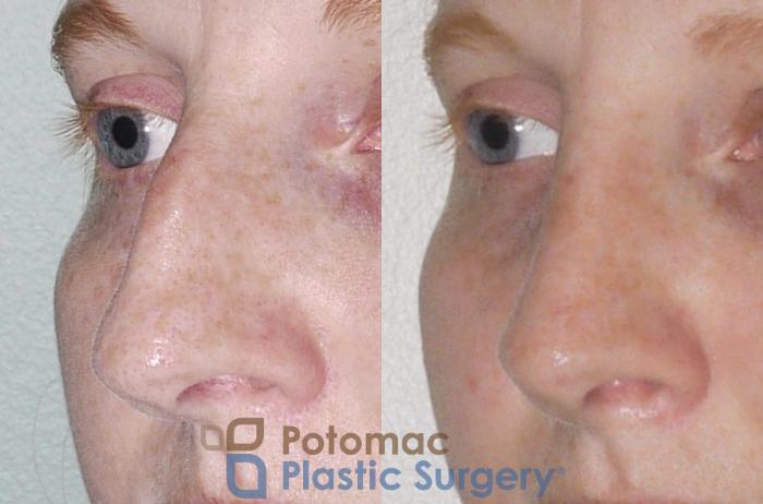 Before & After Rhinoplasty - Cosmetic Case 52 Left Oblique View in Washington DC & Arlington , DC