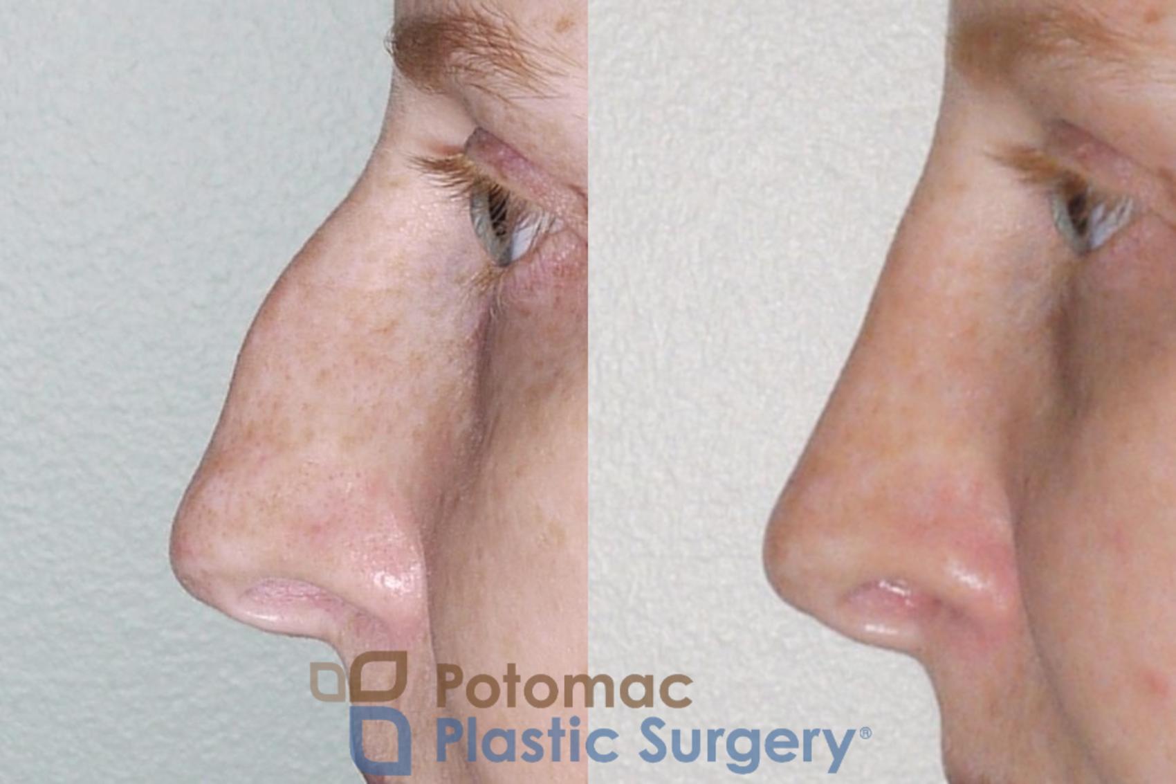 Before & After Rhinoplasty - Medical Case 52 Left Side View in Washington DC & Arlington , DC