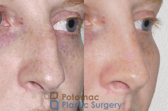 Before & After Rhinoplasty - Cosmetic Case 52 Right Oblique View in Washington DC & Arlington , DC