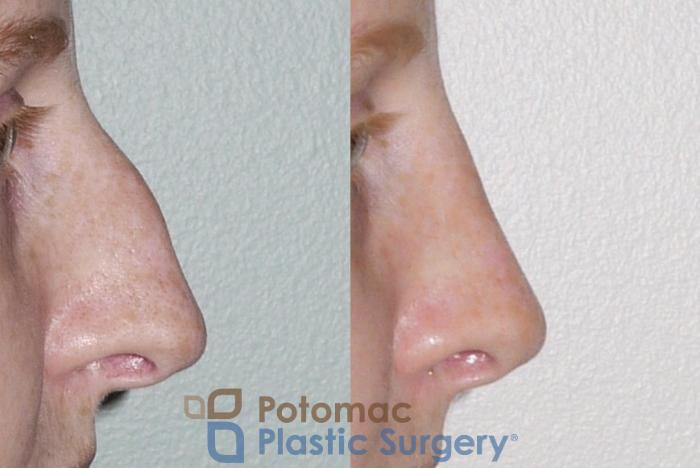 Before & After Rhinoplasty - Cosmetic Case 52 Right Side View in Washington DC & Arlington , DC