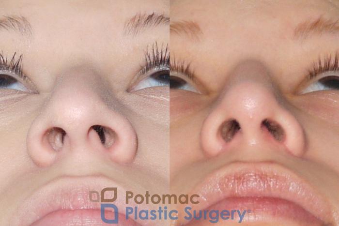Before & After Rhinoplasty - Medical Case 54 Below View in Washington DC & Arlington , DC