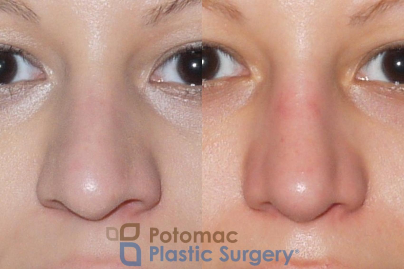 Before & After Rhinoplasty - Cosmetic Case 54 Front View in Washington, DC