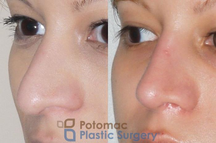 Before & After Rhinoplasty - Medical Case 54 Left Oblique View in Washington DC & Arlington , DC
