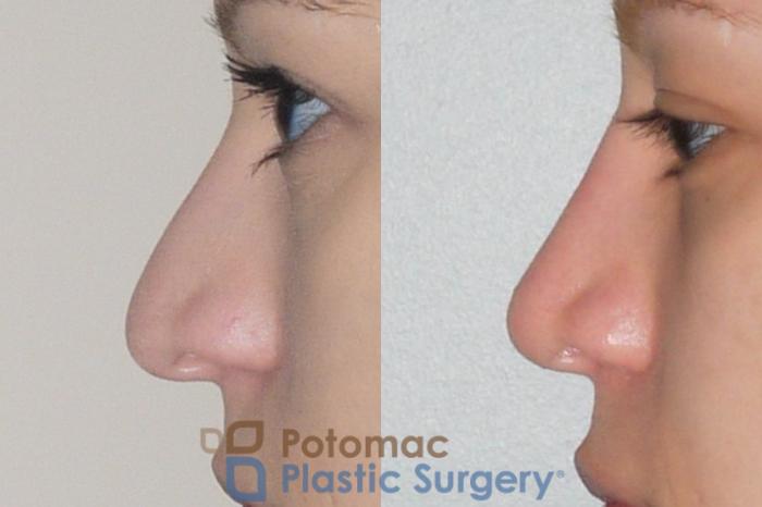 Before & After Rhinoplasty - Cosmetic Case 54 Left Side View in Washington DC & Arlington , DC