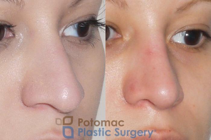Before & After Rhinoplasty - Medical Case 54 Right Oblique View in Washington DC & Arlington , DC