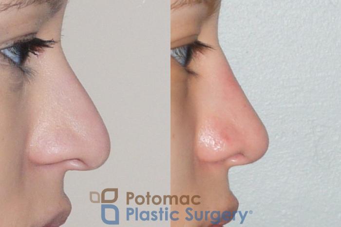 Before & After Rhinoplasty - Medical Case 54 Right Side View in Washington DC & Arlington , DC