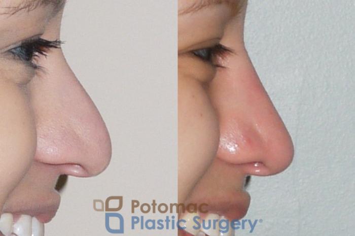 Before & After Rhinoplasty - Cosmetic Case 54 Right Side View #2 View in Washington DC & Arlington , DC