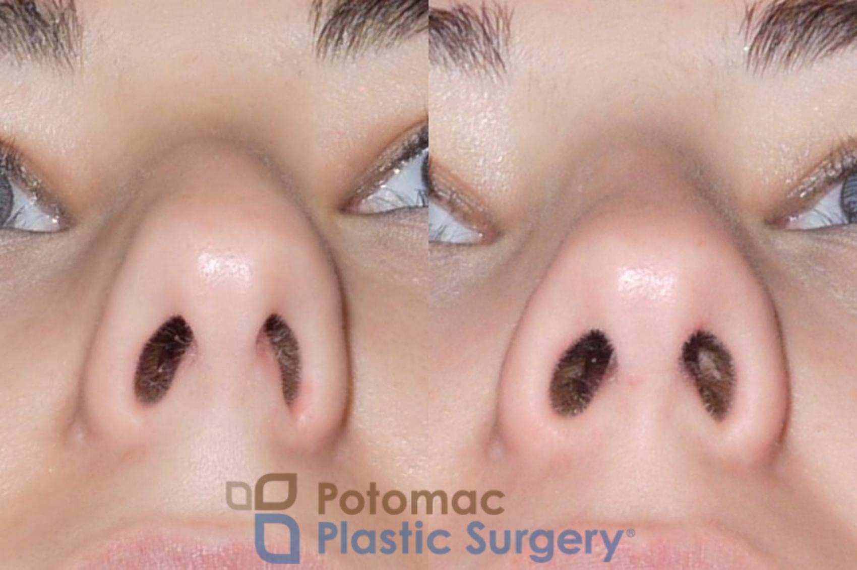 Before & After Rhinoplasty - Cosmetic Case 59 Below View in Washington, DC