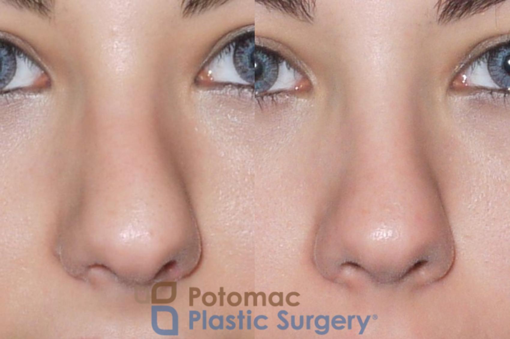 Before & After Rhinoplasty - Cosmetic Case 59 Front View in Washington DC & Arlington , DC