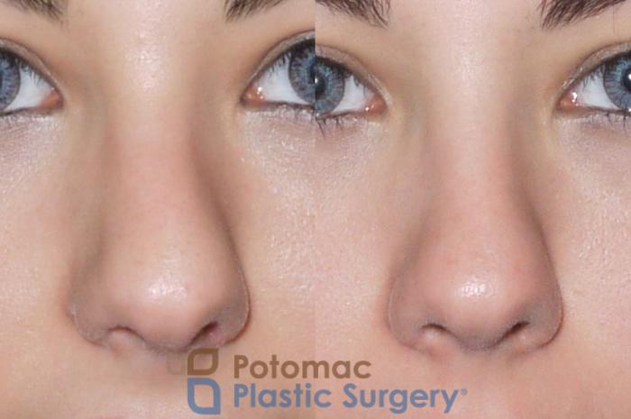 Before & After Rhinoplasty - Cosmetic Case 59 Front View in Washington, DC
