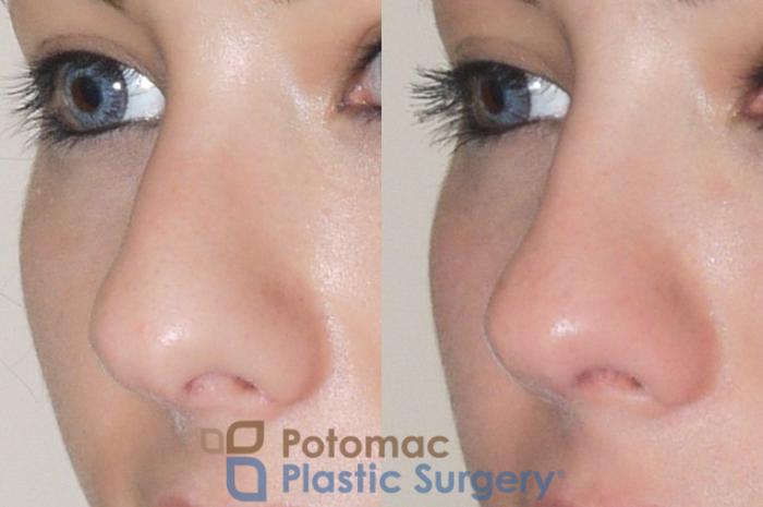Before & After Rhinoplasty - Cosmetic Case 59 Left Oblique View in Washington DC & Arlington , DC