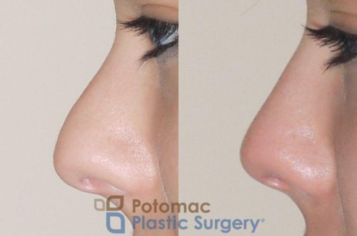 Before & After Rhinoplasty - Medical Case 59 Left Side View in Washington DC & Arlington , DC