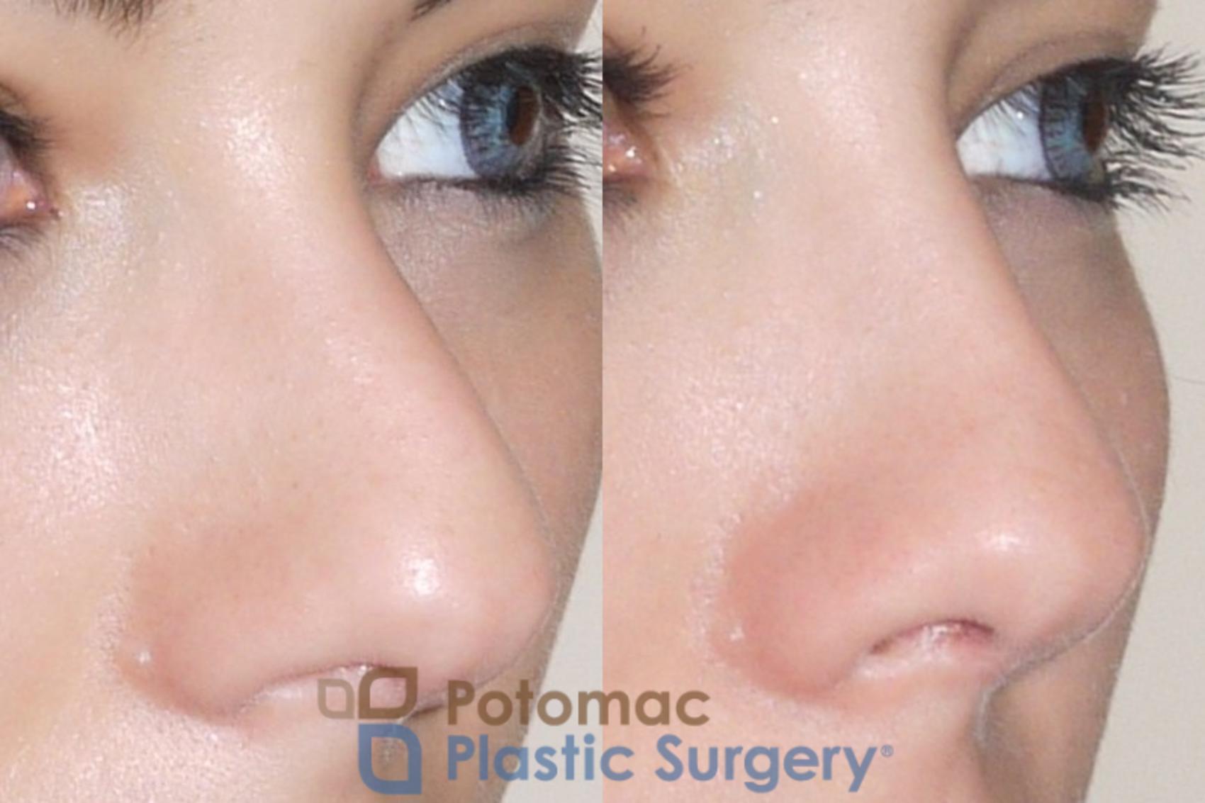 Before & After Rhinoplasty - Cosmetic Case 59 Right Oblique View in Washington, DC