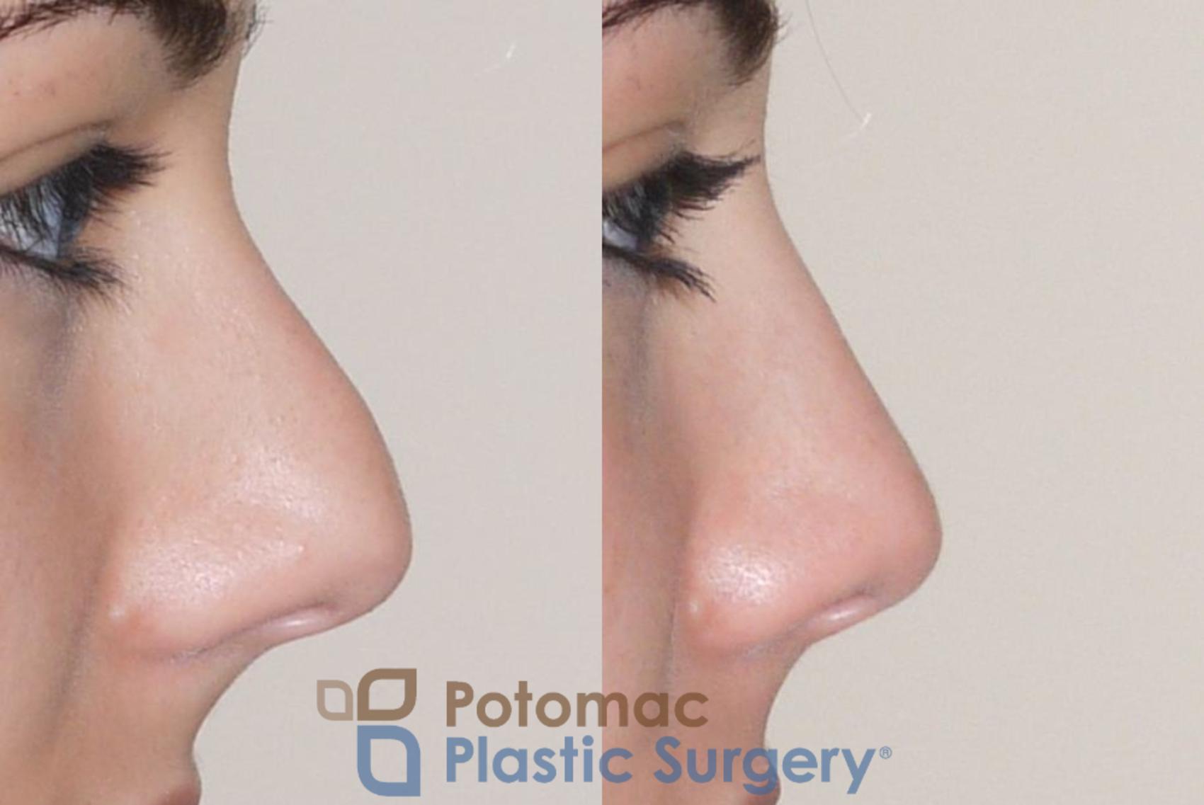 Before & After Rhinoplasty - Cosmetic Case 59 Right Side View in Washington, DC