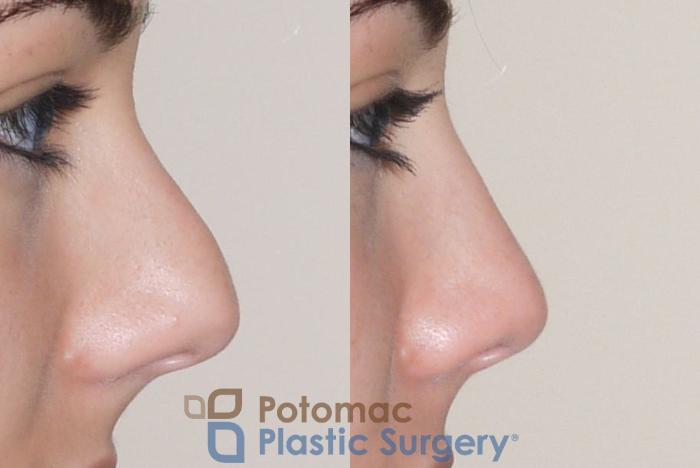 Before & After Rhinoplasty - Medical Case 59 Right Side View in Washington DC & Arlington , DC