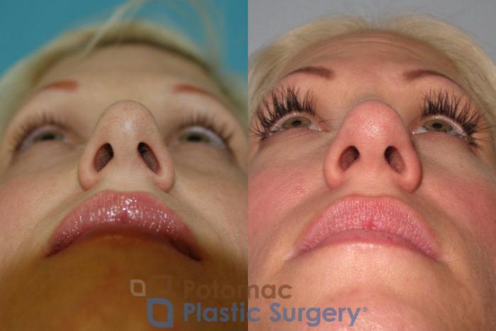 Before & After Rhinoplasty - Medical Case 6 Below View in Washington DC & Arlington , DC