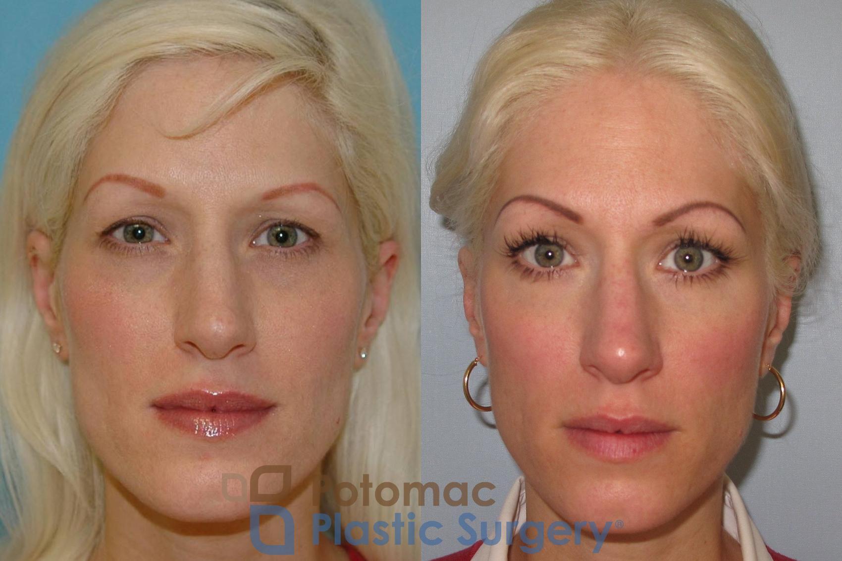 Before & After Rhinoplasty - Cosmetic Case 6 Front View in Washington DC & Arlington , DC