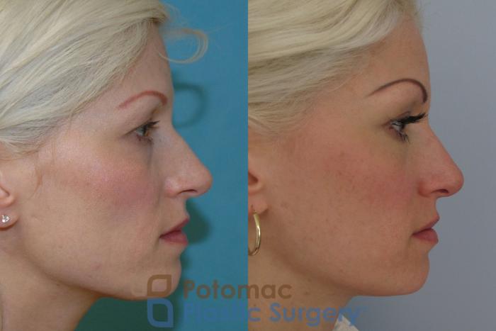 Before & After Rhinoplasty - Medical Case 6 Right Side View in Washington DC & Arlington , DC