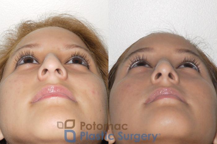 Before & After Rhinoplasty - Medical Case 60 Below View in Washington DC & Arlington , DC
