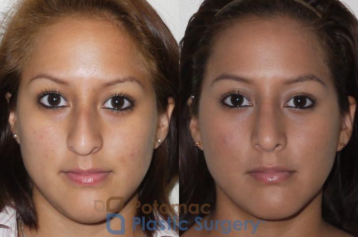 Before & After Rhinoplasty - Cosmetic Case 60 Front View in Washington, DC