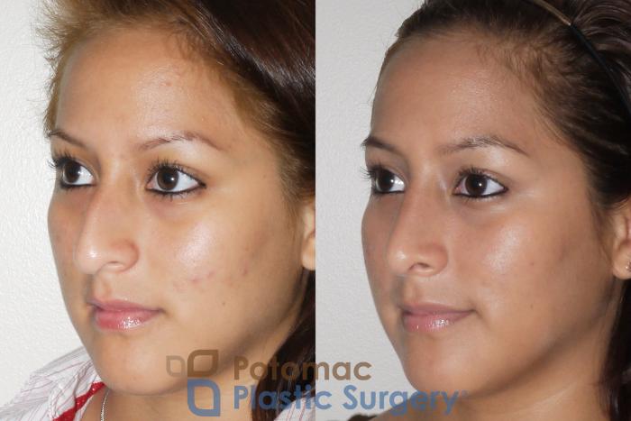 Before & After Rhinoplasty - Medical Case 60 Left Oblique View in Washington DC & Arlington , DC