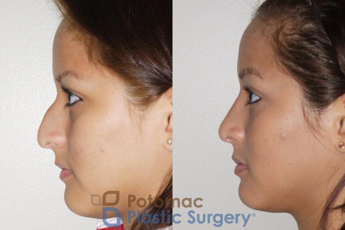 Before & After Rhinoplasty - Medical Case 60 Left Side View in Washington DC & Arlington , DC