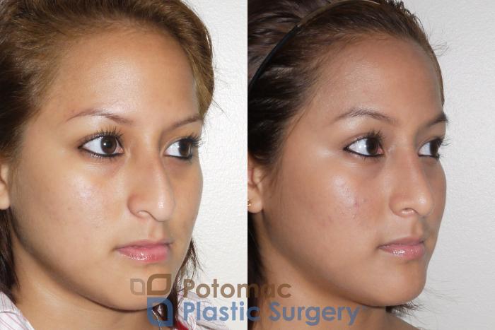 Before & After Rhinoplasty - Cosmetic Case 60 Right Oblique View in Washington DC & Arlington , DC