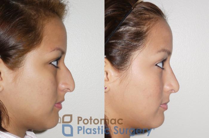 Before & After Rhinoplasty - Medical Case 60 Right Side View in Washington DC & Arlington , DC