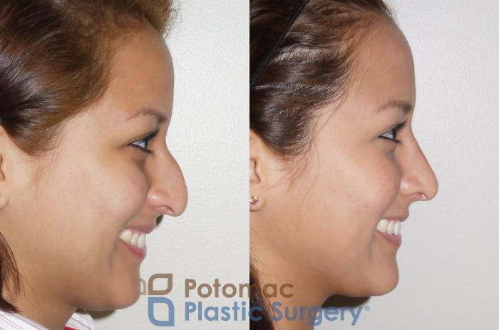 Before & After Rhinoplasty - Medical Case 60 Right Side View #2 View in Washington DC & Arlington , DC