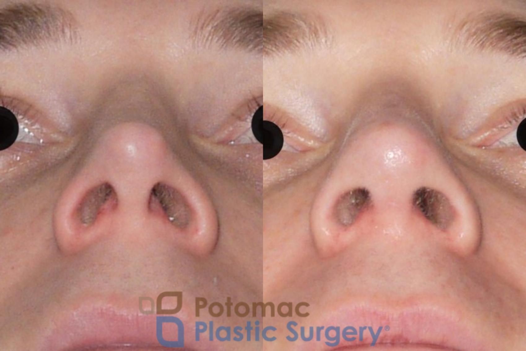 Before & After Rhinoplasty - Cosmetic Case 61 Below View in Washington, DC