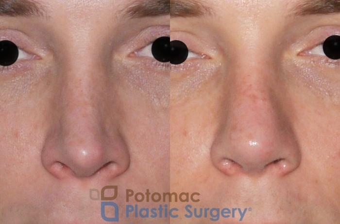 Before & After Rhinoplasty - Medical Case 61 Front View in Washington DC & Arlington , DC