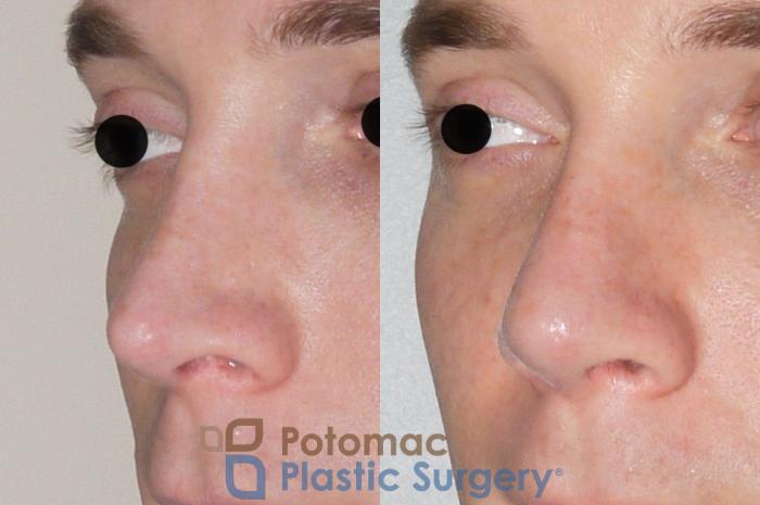 Before & After Rhinoplasty - Medical Case 61 Left Oblique View in Washington DC & Arlington , DC