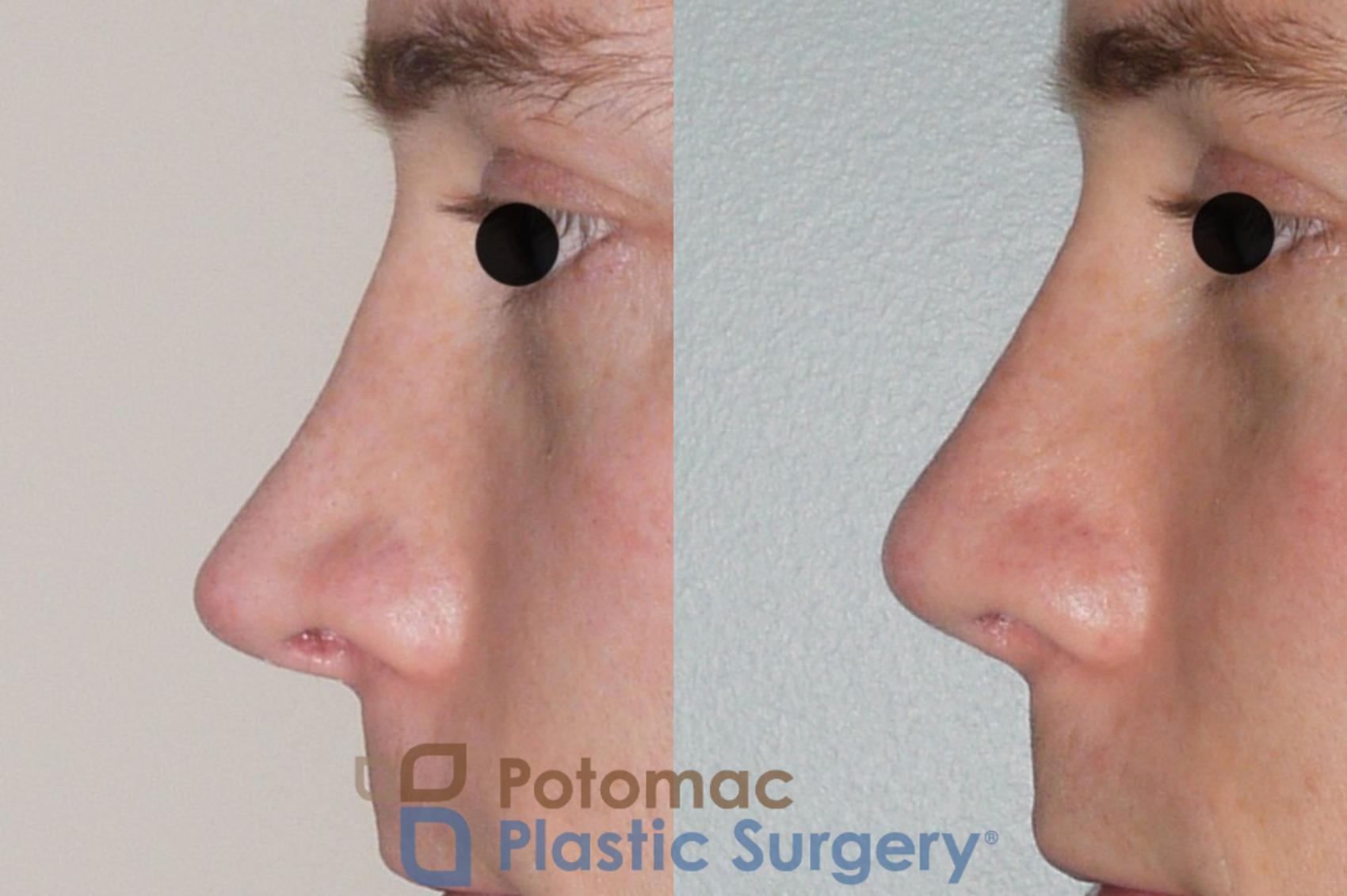 Before & After Rhinoplasty - Cosmetic Case 61 Left Side View in Washington, DC