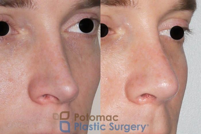 Before & After Rhinoplasty - Medical Case 61 Right Oblique View in Washington DC & Arlington , DC