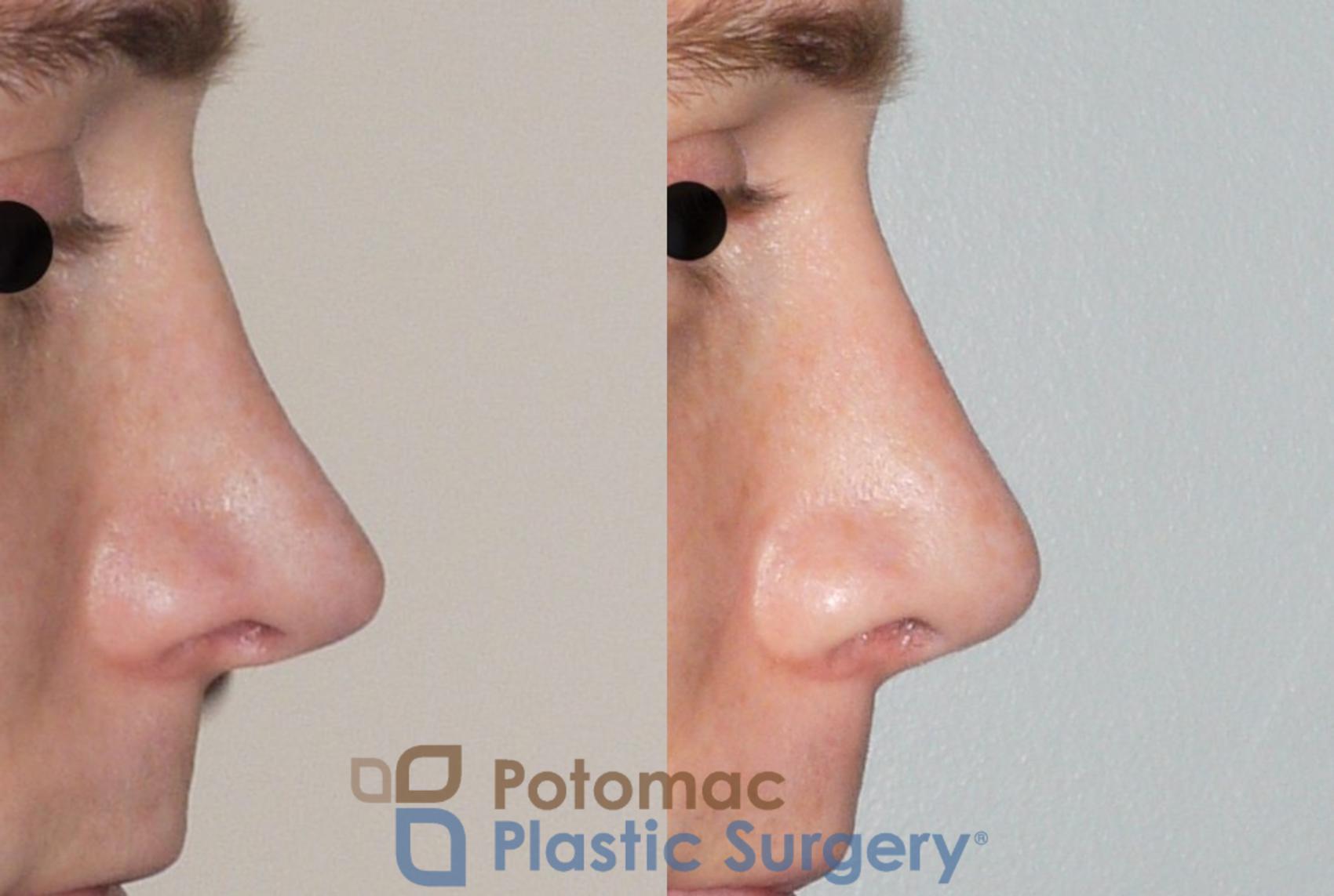 Before & After Rhinoplasty - Cosmetic Case 61 Right Side View in Washington, DC