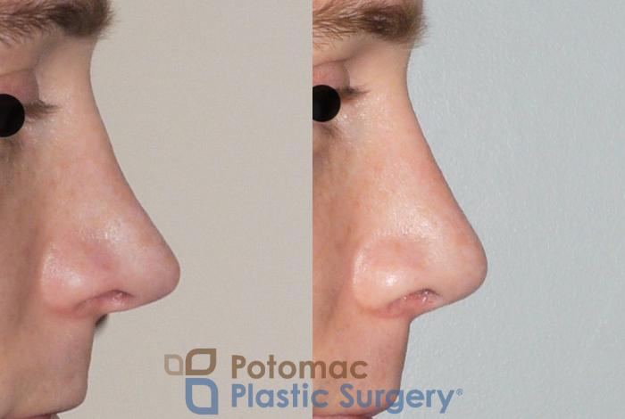 Before & After Rhinoplasty - Medical Case 61 Right Side View in Washington DC & Arlington , DC