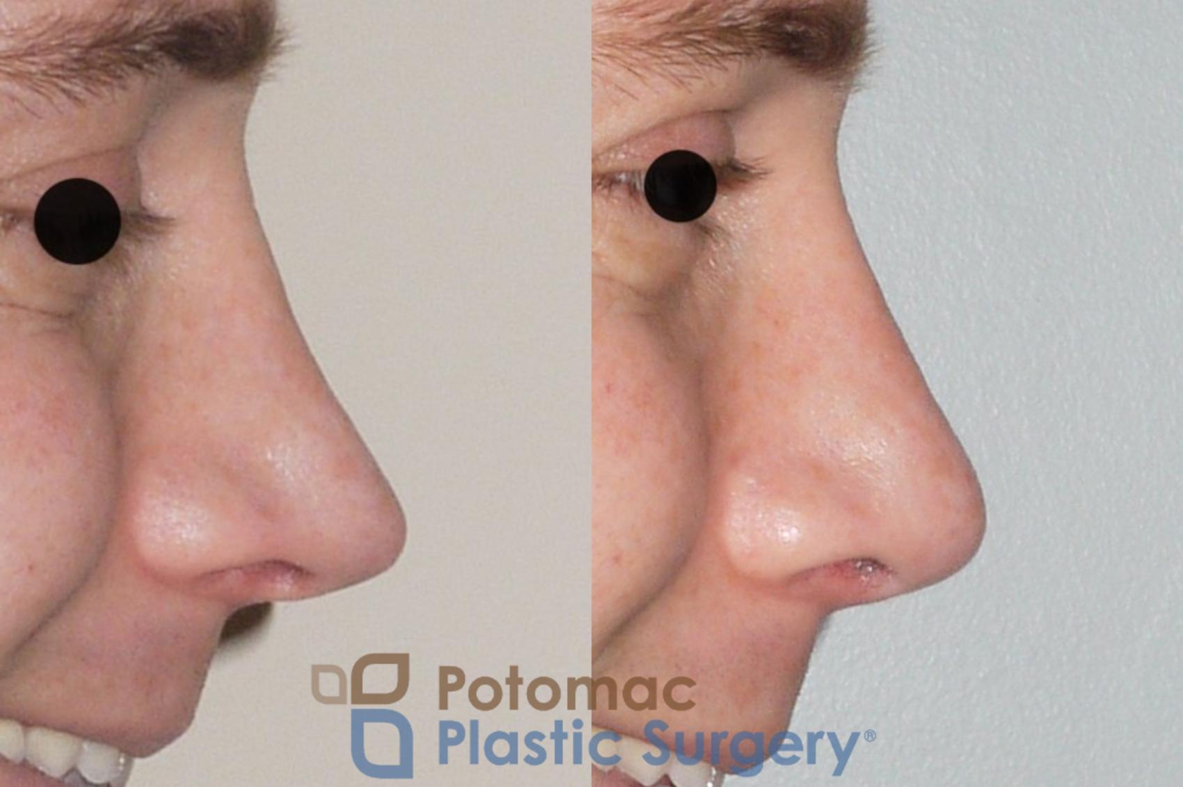 Before & After Rhinoplasty - Cosmetic Case 61 Right Side View #2 View in Washington, DC