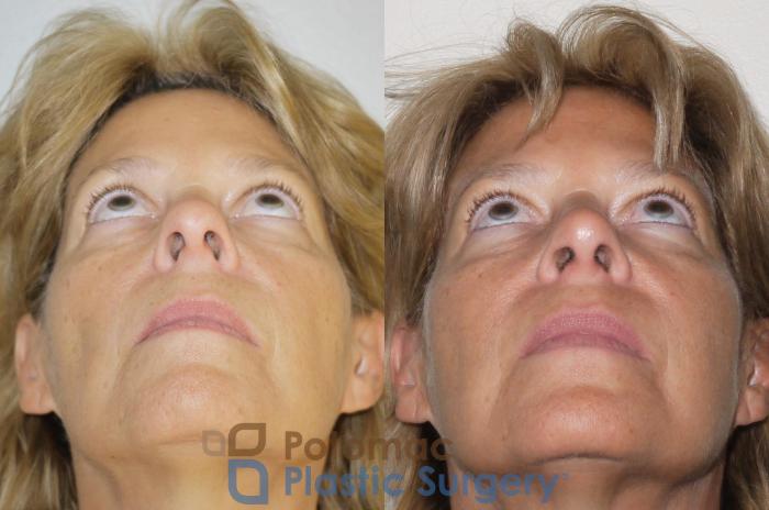Before & After Rhinoplasty - Cosmetic Case 63 Below View in Washington DC & Arlington , DC