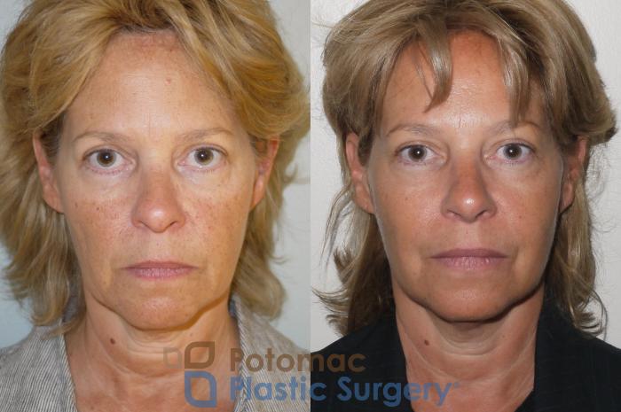 Before & After Rhinoplasty - Cosmetic Case 63 Front View in Washington DC & Arlington , DC