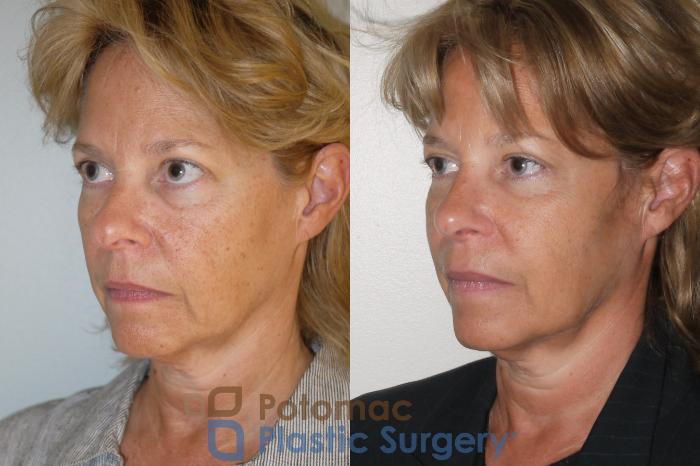 Before & After Rhinoplasty - Cosmetic Case 63 Left Oblique View in Washington DC & Arlington , DC