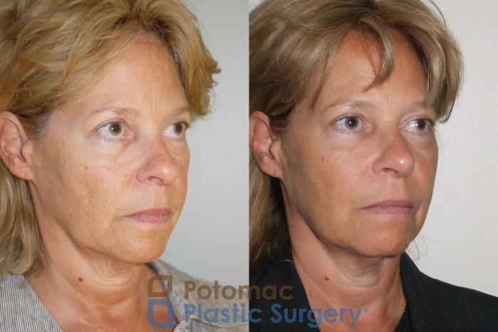 Before & After Rhinoplasty - Cosmetic Case 63 Right Oblique View in Washington DC & Arlington , DC