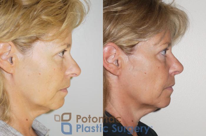 Before & After Rhinoplasty - Cosmetic Case 63 Right Side View in Washington DC & Arlington , DC