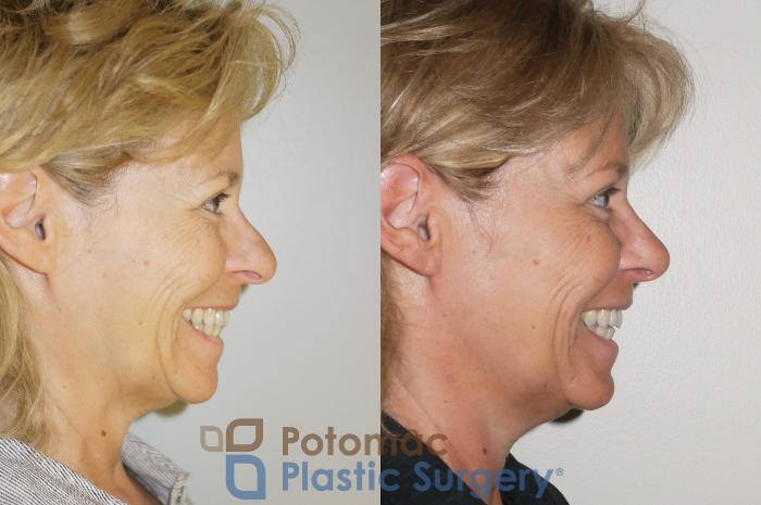 Before & After Rhinoplasty - Cosmetic Case 63 Right Side View #2 View in Washington DC & Arlington , DC
